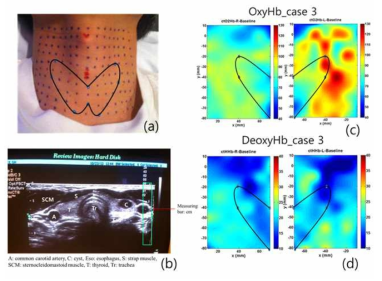 두경부 진단에서 타당성 검토를 위한 실험 수행과 프로토콜 확립을 위한 공동 선행 연구 수행: Measurement of Normal Thyroid Gland Using Diffuse Optical Spectroscopic Imaging (DOSI) to Obtain Baseline Data for Screening of Thyroid Dysfunction