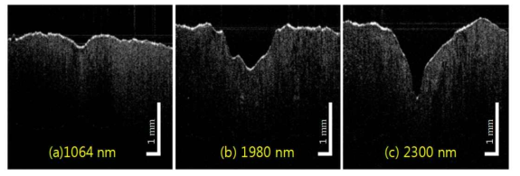 고해상도 광간섭 단층 영상을 이용한 레이저 tissue ablation 성능평가