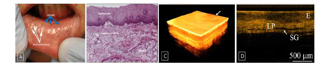 구강 점막 혈관 측정 A) 구강 점막의 소침샘과 혈관, B) 병리 소견(H&E X100), SS-OCT 상의 구강 점막과 하부 구조, D) SS-OCT 상의 횡축 단면(E: Epithelium, LP: Lamian propria, SG: Salivary gland)