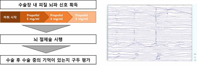 (좌) 마취 중 피질 뇌파 측정 패러다임, (우) 프로포폴 마취 중 피질 뇌파의 예