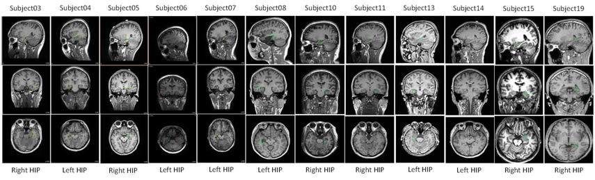 12명 피험자의 해마(hippocampus, HIP) 뇌파 측정 위치