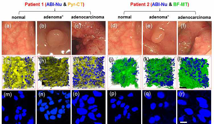 실제 사람의 대장조직을 이용한 정상, 종양, 암을 관찰한 이광자 형광 이미지