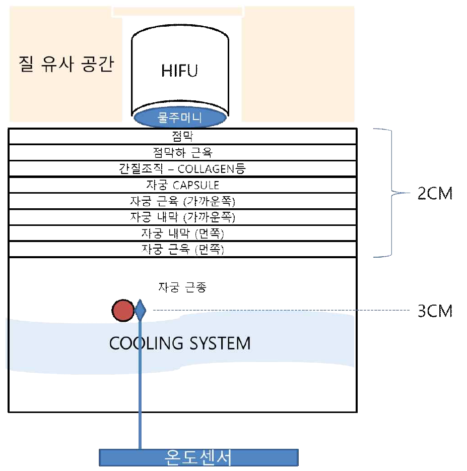 질 유사 공간 적용. HIFU PROBE 가 CANAL 안에 위치하여 상대적으로 열 배출이 어려움