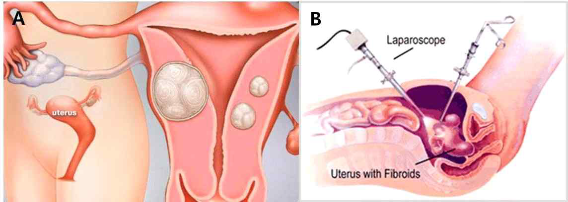 인체내 자궁의 위치와 자궁근종의 개념도(A) 와 자궁근종 복강경 수술 개념도 (B)