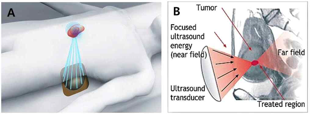 고강도 집속 초음파 (HIFU) 의 치료 개념도 (A) 와 HIFU 의 자궁근종 치료 모식도 (B)