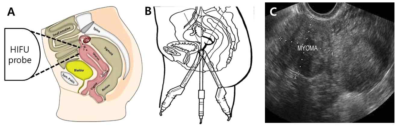 복부를 통한 HIFU 치료의 개념도 (A) 와 질을 통한 HIFU 치료의 개념도 (B), 질을 통해 프로브를 넣었을 때 프로브와 자궁근종이 밀착된 초음파 영상 (C)