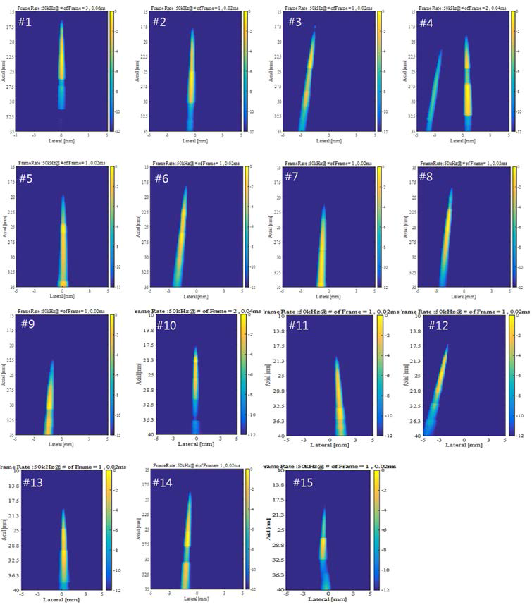 Micro-convex 변환자 기반 PAM-SSCF의 Cavitation detection 정확도 평가 결과