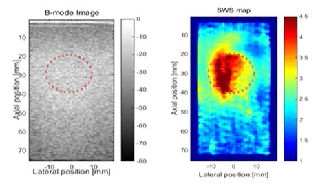 B-mode영상(좌측)과 HIFU-induced SWE영상