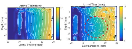 HIFU 조사 전(좌측), 후(우측)의 횡파 도달 시간 영상
