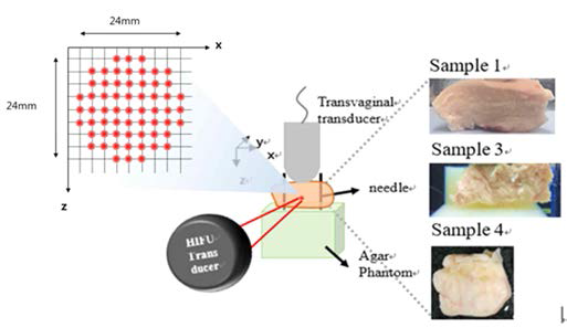 HIFU 자궁 근종 조직 실험 환경