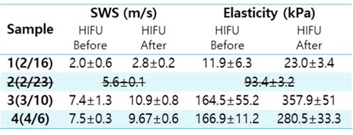 자궁 근종 HIFU 조사 전과 후의 측정된 SWS 및 탄성도