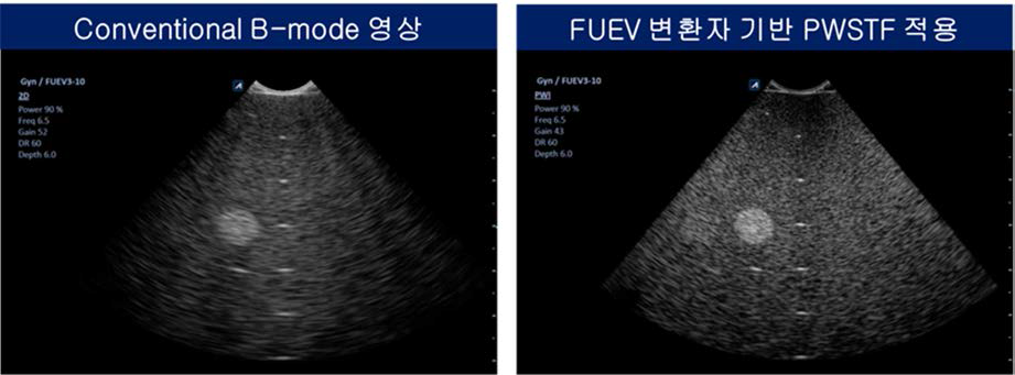 고속․고해상도 초음파 영상 기법 FUEV 최적화 구현 영상