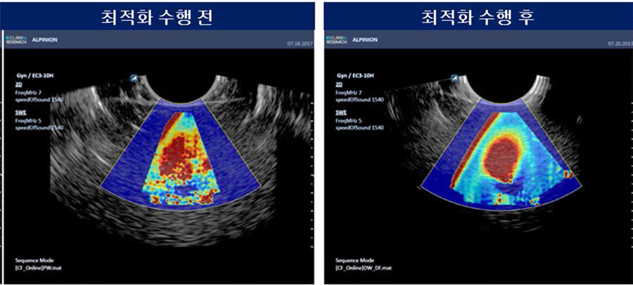 최적화 수행 전/후 shearwave elastography영상