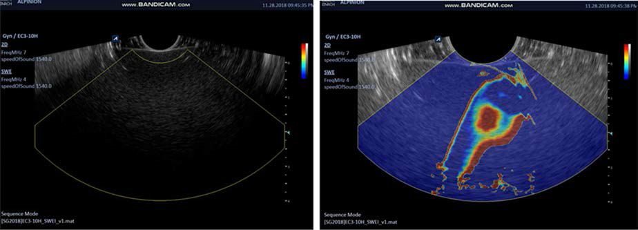 (좌) 일반 B-mode 영상 (우) 실시간 구동중인 shearwave elastography영상