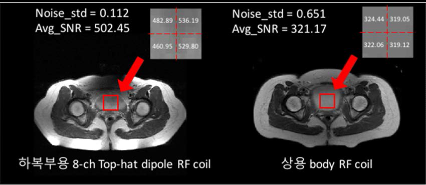 하복부용 8-channel Top-Hat dipole antenna와 상용 Body RF coil의 비교 영상 및 SNR