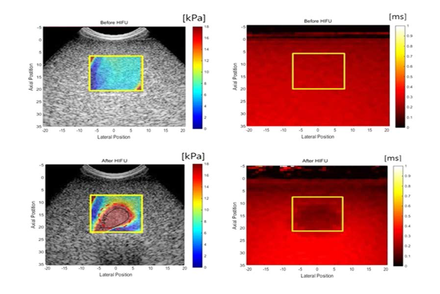 Graphite 팬텀의 HIFU 인가 전·후 초음파 SWEI 영상 (좌)과 MRI 기반의 T1 영상 (우)
