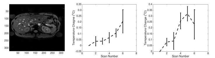 개발된 fat과 water에서 동시에 호환되는 온도영상법을 in-vivo abdomen에 적용한 온도 변화. (좌) Magnitude image, (중앙) Non-suppressed PRF-based MR thermometry, (우) Fat-suppressed PRF-based MR thermometry
