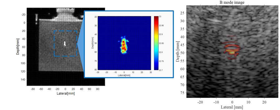 MR 온도영상 (좌)과 초음파 초점 영상화 방법 (우)