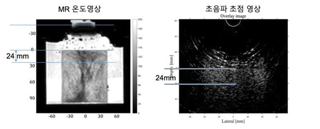 팬텀에서 MR 온도영상과 초음파 초점영상을 비교한 영상