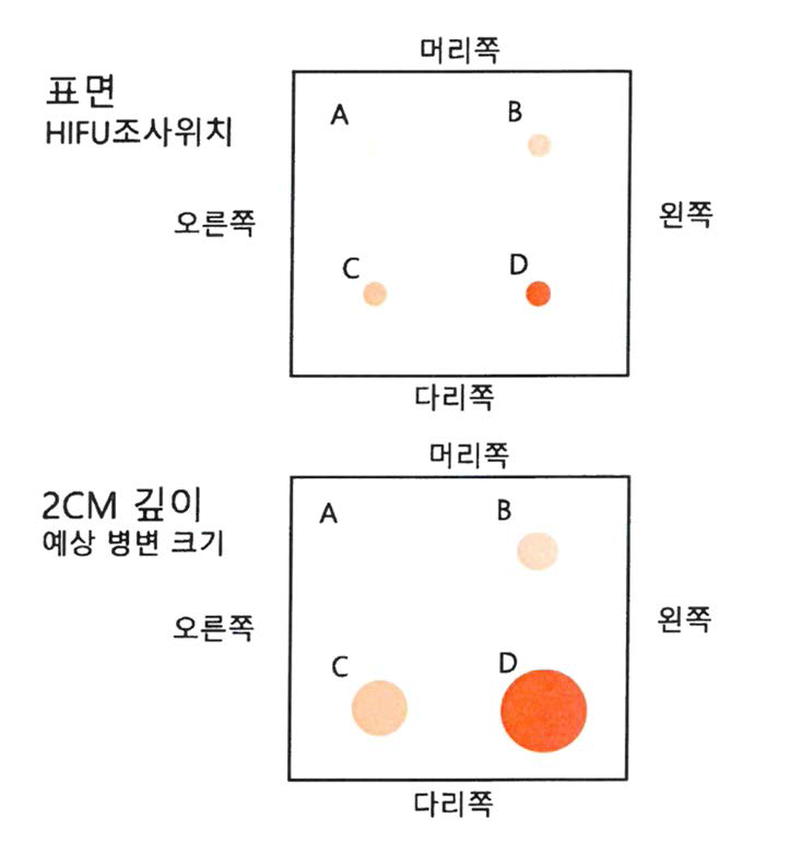 HIFU 조사 위치 및 예상 병변의 크기