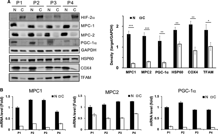 사람의 신장암 조직에서 MPC, PGC-1a의 발현이 감소되어 있음. 신장암 세포는 glucose를 이용한 mitochondrial respiration이 억제되어 있으며 정상 조직과 비교했을 때 신장암 조직에서 MPC의 발현이 감소되어 있음을 관찰함. 미토콘드리아의 생성 및 기능에 중요한 PGC-1a의 발현 또한 감소되어 있음