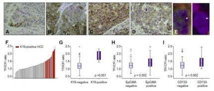 간암줄기세포표지자 양성인 간세포암에서 telomere의 길이