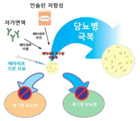 베타세포 기반 치료와 당뇨병