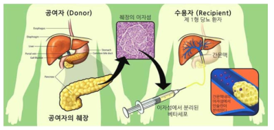 베타세포 이식 치료