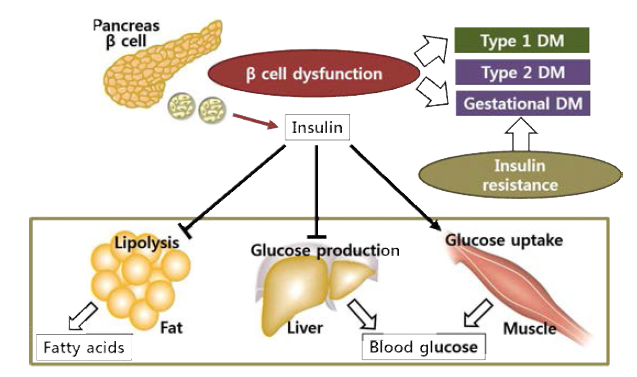 당뇨병의 분류와 당뇨병 발병과정에서 베타세포의 중요성
