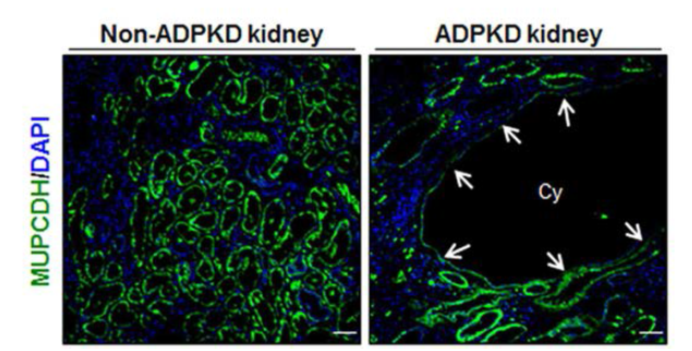 ADPKD 신장조직에서 저발현 되어있는 MUPCDH 유전자