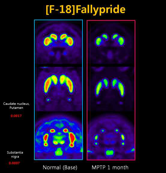 각 영역에서의 D2 receptor의 변화 ([18F]Fallypride)
