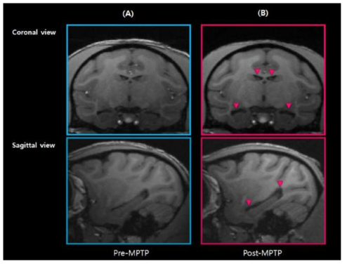 MPTP를 투여한 원숭이 질병모델의 7T MRI영상. 붉은 색 파살표는 위축된 부위