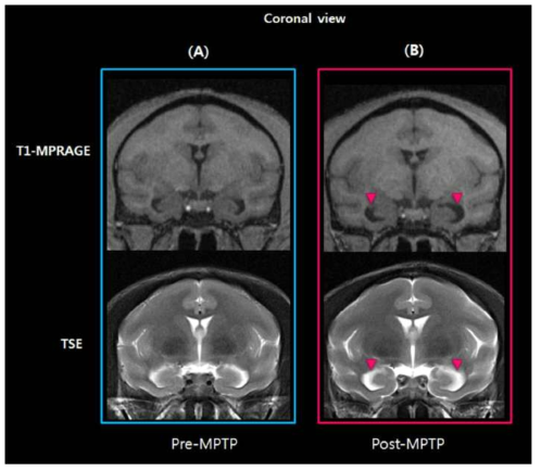 MPTP를 투여한 원숭이 모델에서의 3T MRI T1, TSE 영상. 붉은 화살표는 lateral ventricle에서 변화가 관찰된 부위