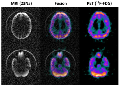 3차원 뇌팬텀에 대한 PET/MR 동시 영상 23Na MRI 영상, PET/MR 정합 영상, 18F-FDG PET 영상
