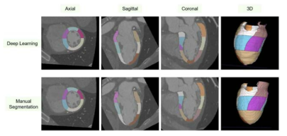 심근의 인공지능 분할결과 (위)와 수동분할결과 (아래) 예시. 2018년 북미영상의학회에 구연으로 채택되어 발표함
