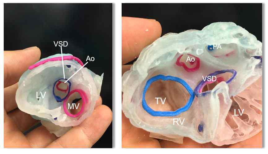 복잡심기형환자에서 3D-프린팅을 이용하여 수술계획을 세우는 예 (1세환아의 심장CT - 양대혈관 우심실 기시)