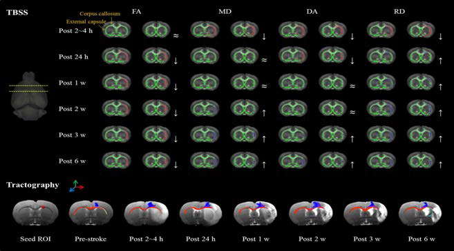 Stroke 발생 전, 후의 DTI-derived parameter TBSS 및 tractography 분석 비교