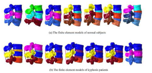 The finite element (FE) models for normal subjects and kyphosis patients