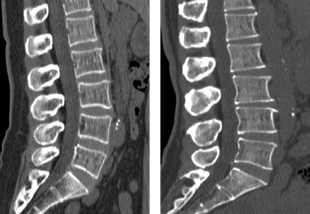 Computed tomography image of normal lumbar spine
