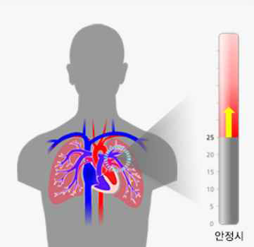 폐동맥고혈압은 폐와 심장을 연결해주는 동맥(폐동맥)에서 나타나는 심각한 질병으로 폐동맥압의 상승과 이와 동반된 우심실부전이 특징임