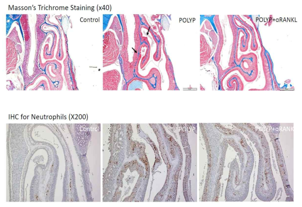 RANKL blocking 시 bone remodeling pattern