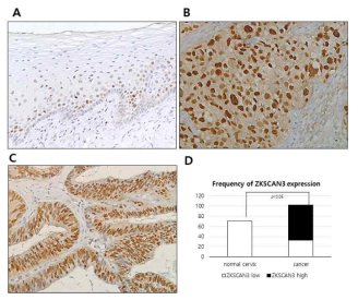 ZKSCAN3 expression in uterine cervical cancer cells and adjacent non-neoplastic mucosa. A. ZKSCAN3 is not expressed at non-neoplastic squamous epithelial cells except for basal cells. B. ZKSCAN3 is strongly expressed at the nucleus of squamous cell carcinoma of uterine cervix. C. cervical adenocarcinoma shows strong expression of ZKSCAN3. D. Comparison of frequency of ZKSCAN3 overexpression between cervical cancer cells versus non-neoplastic cervical mucosae. (200X)