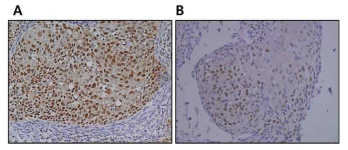 Representative samples of ZKSCAN3 expression in uterine cervical cancer. A. Strong nuclear expression of ZKSCAN3 in squamous cell carcinoma of cervix. B. Weak expression of ZKSCAN3 in squamous cell carcinoma of uterine cervix. (200X)