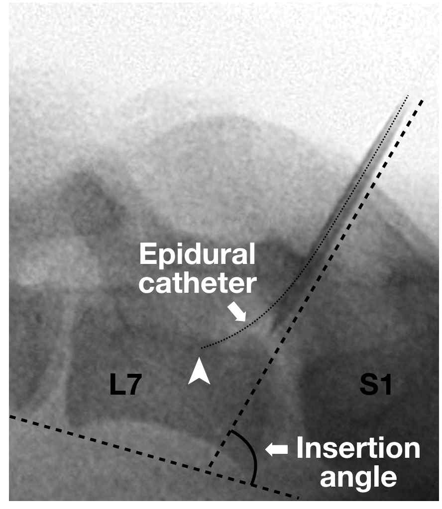 경막외마취침의 각도와 경막외카테터의 삽입
