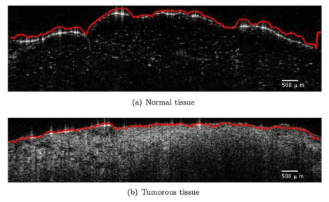 (a) 정상 세포 OCT 영상, (b) 유방암의 OCT 영상