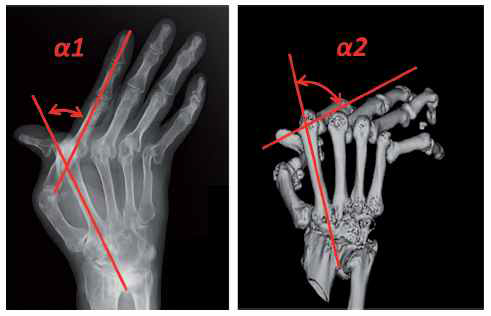 ulnar flexion angle 측정에서의 x-선 검사(좌)와 3DCT(우)의 차이