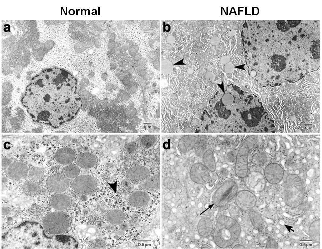 전자현미경을 이용한 정상간과 비알콜성 지방간의 미토콘드리아 형태학적 변화 차이