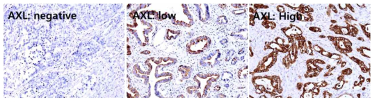 담도암에서 AXL의 면역화학염색