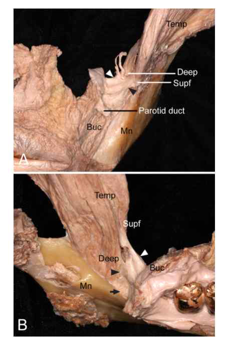 Spatial relationship of the connecting fascia between the buccinator (Buc) and the tendons of temporalis (Temp). (A) The fascia (arrowheads) encircled the space between the superficial tendon (Supf) and the deep tendon (Deep) of the Temp laterally, and the external surface of the Buc medially. The fascia blended with the buccopharyngeal fascia surrounding the Buc. (B) An internal view of the mandible (Mn) revealing that the connecting fascia (arrowheads) between the Buc and the tendons of the Temp was fused with the periosteum (arrow) of the Mn