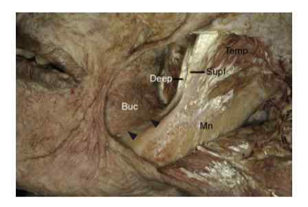 Relationship between the buccinator (Buc) and the deep tendon (Deep) of the temporalis (Temp). The inferior fibers of the Buc (arrowheads) arose from the Deep of the T emp. Mn, mandible; Supf, superficial tendon of the temporalis